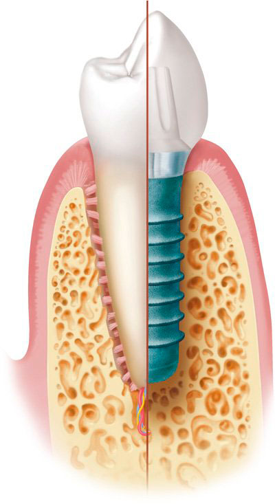 Skizze Implantat und natürlicher Zahn